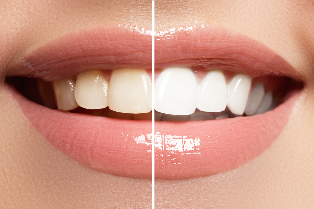 Tooth Whitening before and after