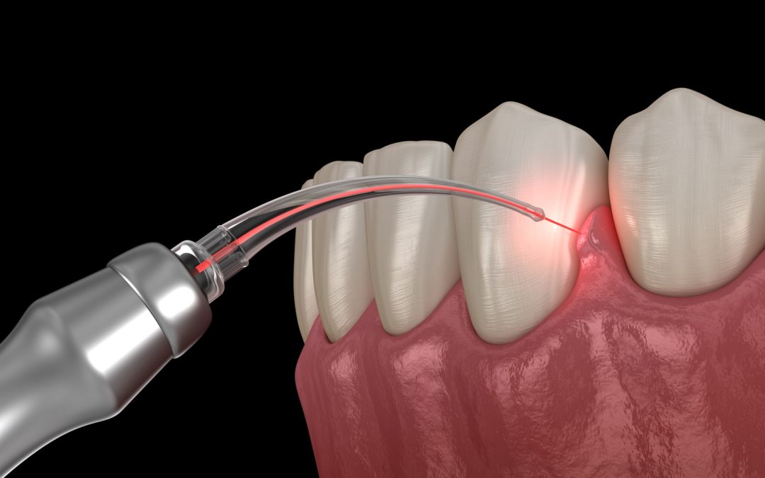 How The Dental Laser Is Breaking The Dental Drill Paradigm