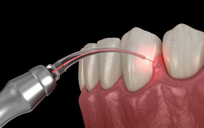 How The Dental Laser Is Breaking The Dental Drill Paradigm
