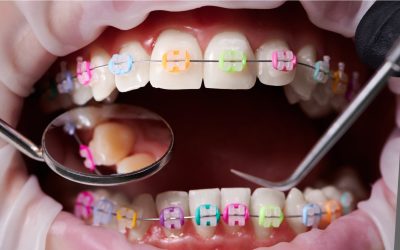 How Braces Help Improve Oral Health and Appearance
