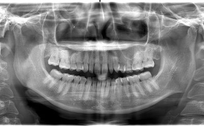 Peg laterals And How Dentist’s Can Treat Them