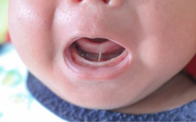 What Being Lip-Tied or Tongue-Tied Means For Children