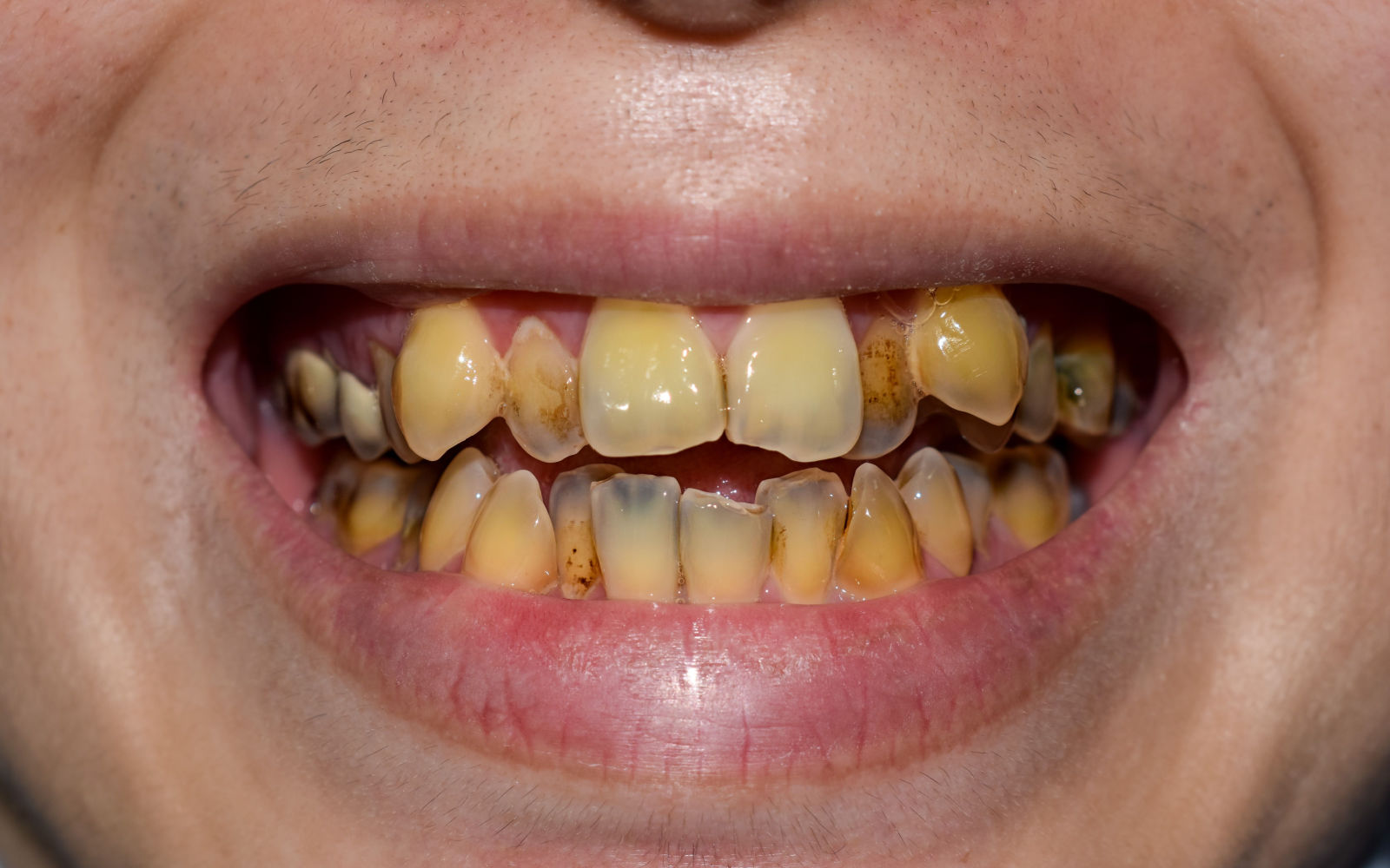 what-distinguishes-a-cavity-from-a-stain-council-bluffs-ia