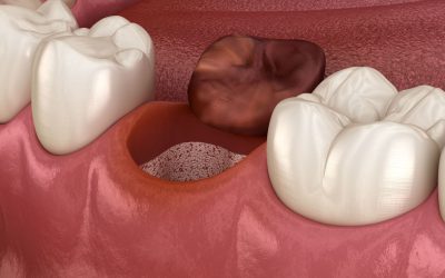 How to Get Rid of Dry Socket? 3 Home Remedies That Help