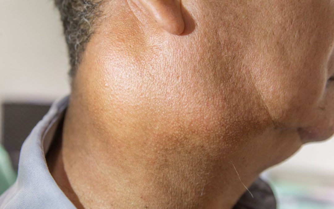 The Fundamentals of Salivary Gland Disorders