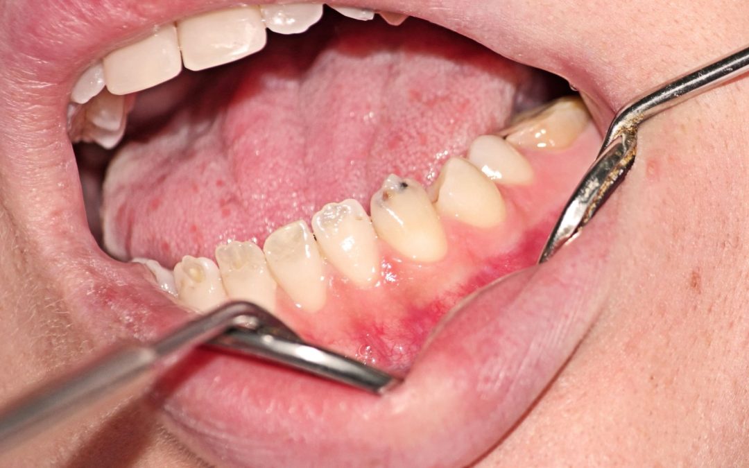 Eroded Enamel from Dentinogenesis Imperfecta
