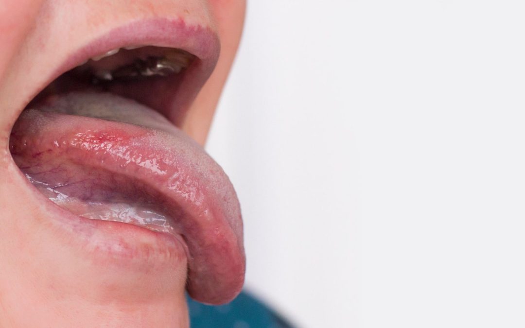 When To Seek Help For Oral Lichen Planus