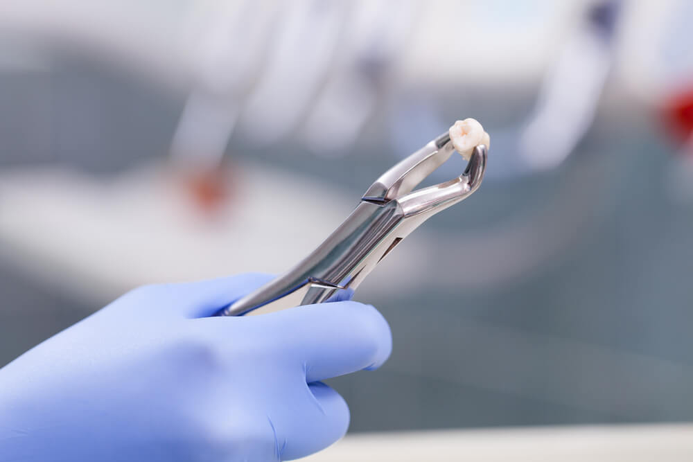 Navigating Your Tooth Extraction Journey with Dr. Steven Fidone