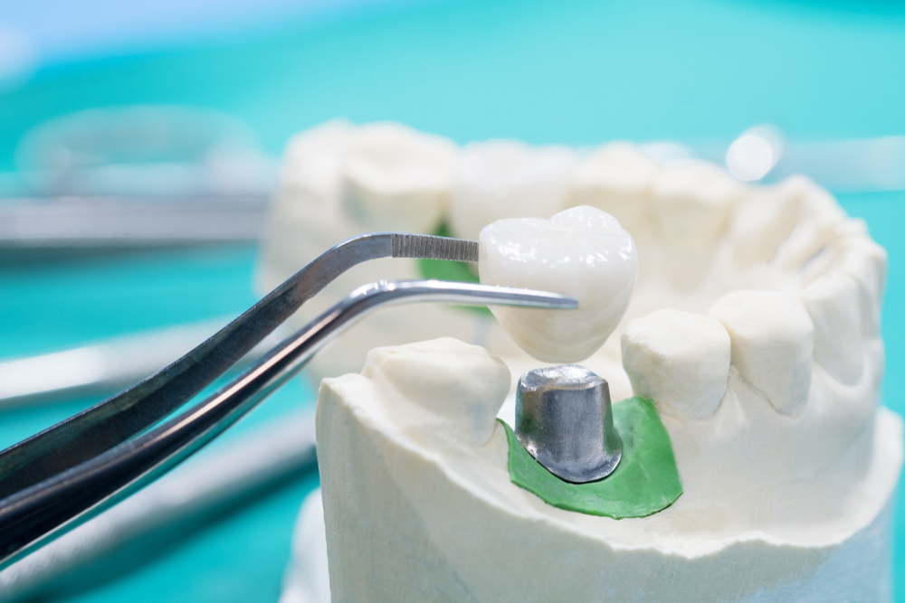 Dental Crowns and Bridges 101: Restoration, Replacement, and Aesthetics