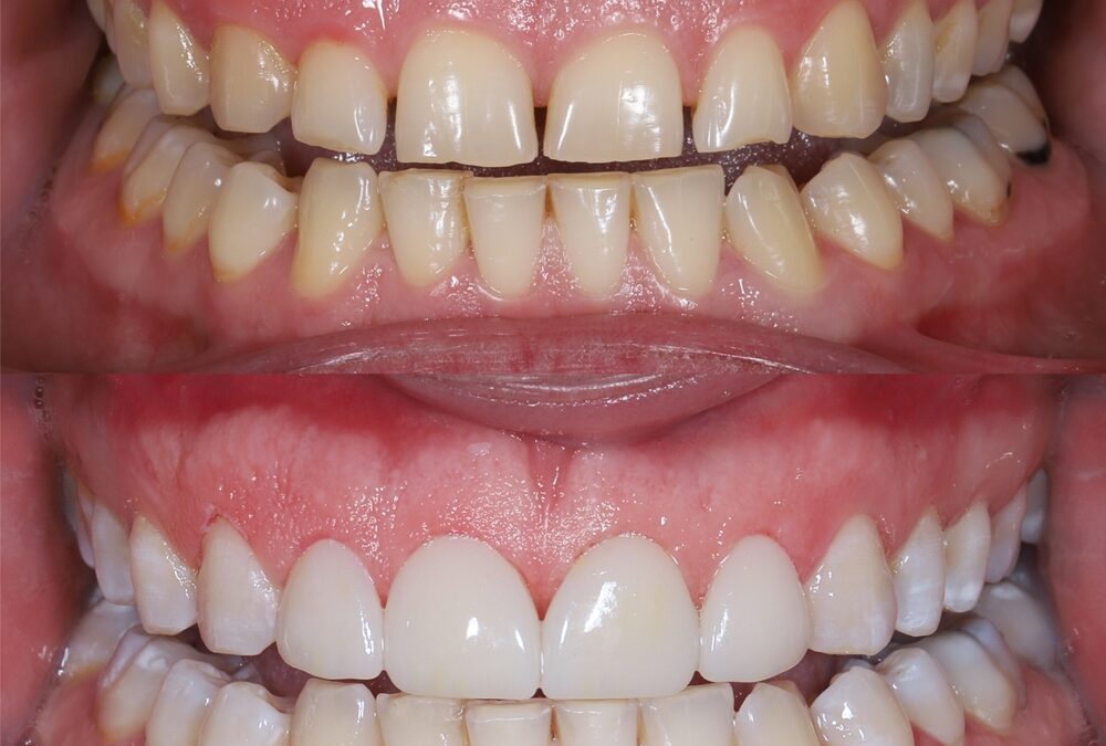 The Causes of Tooth Discoloration: Intrinsic vs. Extrinsic Stains