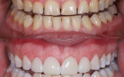 The Causes of Tooth Discoloration: Intrinsic vs. Extrinsic Stains