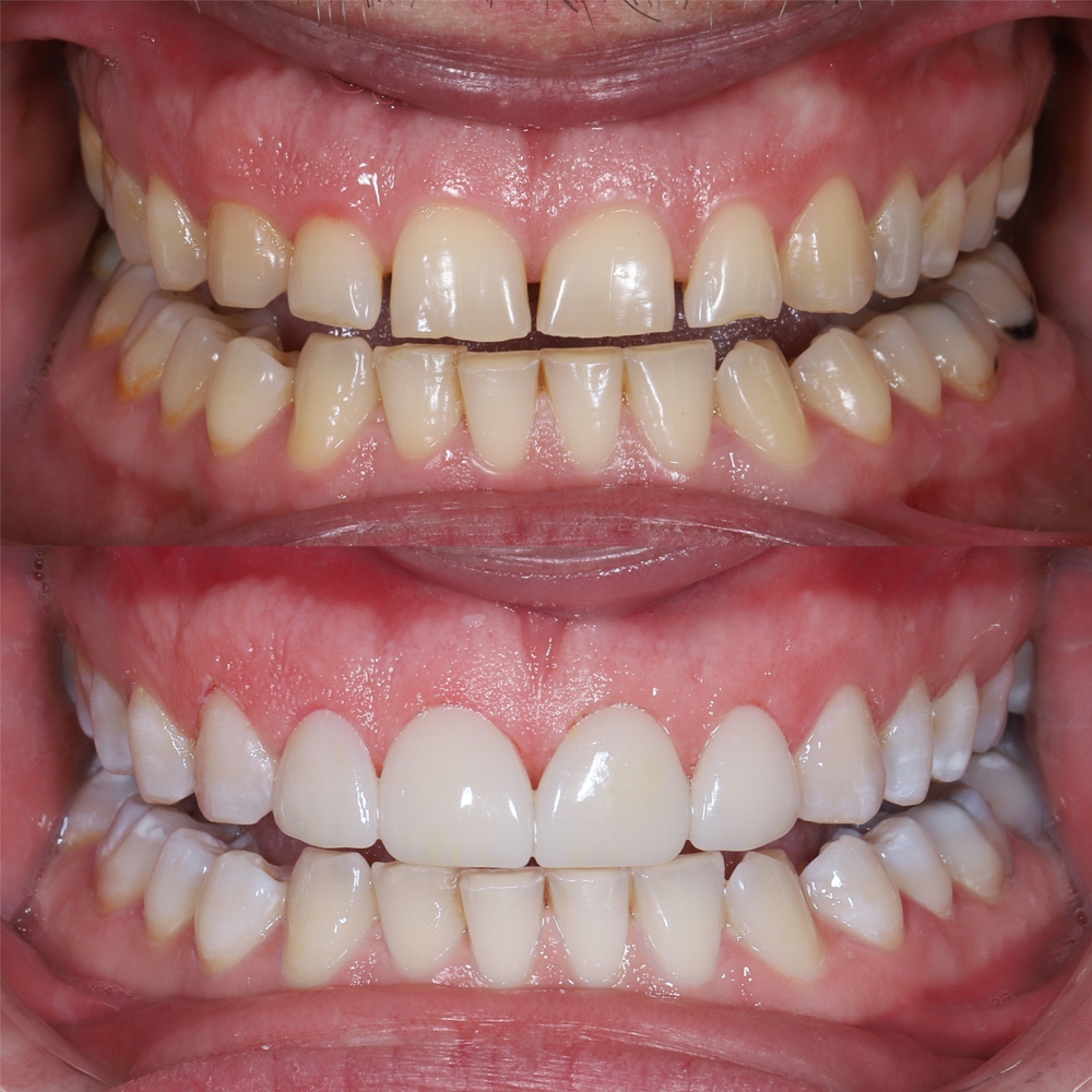 The Causes of Tooth Discoloration: Intrinsic vs. Extrinsic Stains