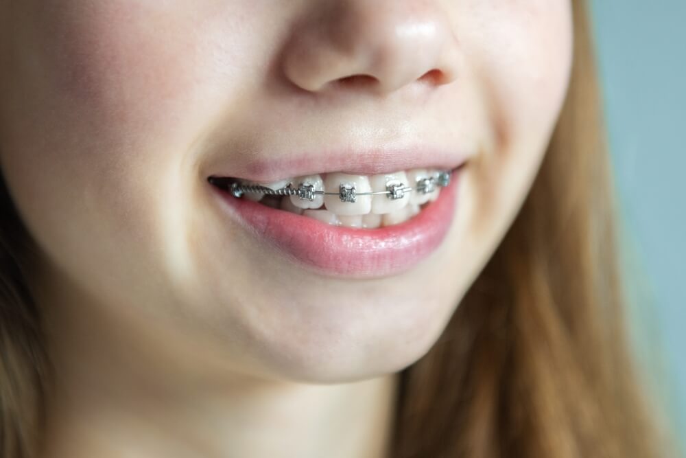 Girl with braces