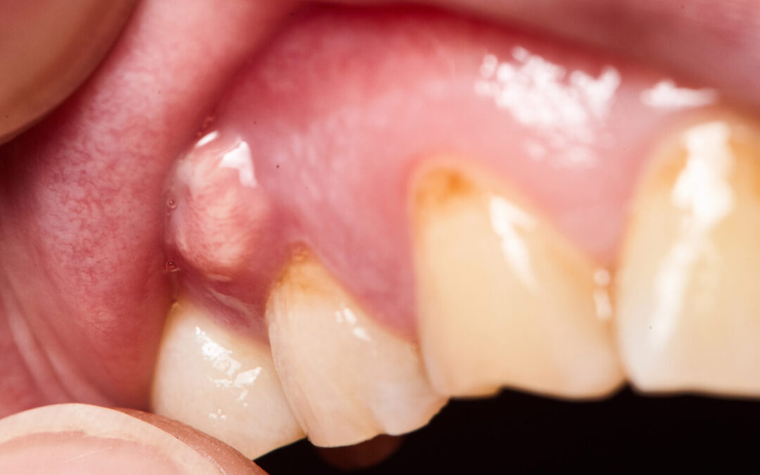 How to Handle a Dental Abscess: Understanding and Managing Oral Infections