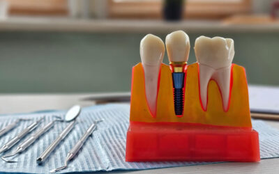 How to Care for Dental Implants