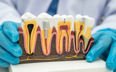 The Facts About Root Canals
